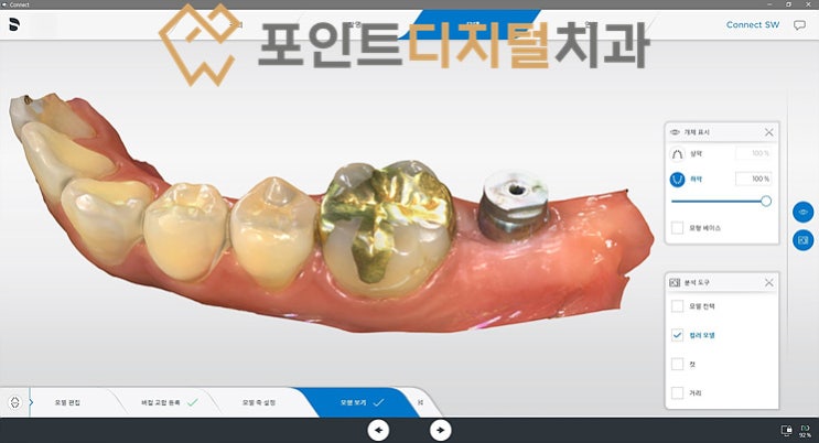  [탕정치과]  iGBR(급속골이식) + PDRN(연어주사) + 디지털 가이드 + 하이니스 디지털 보철 임플란트 / 천안 아산