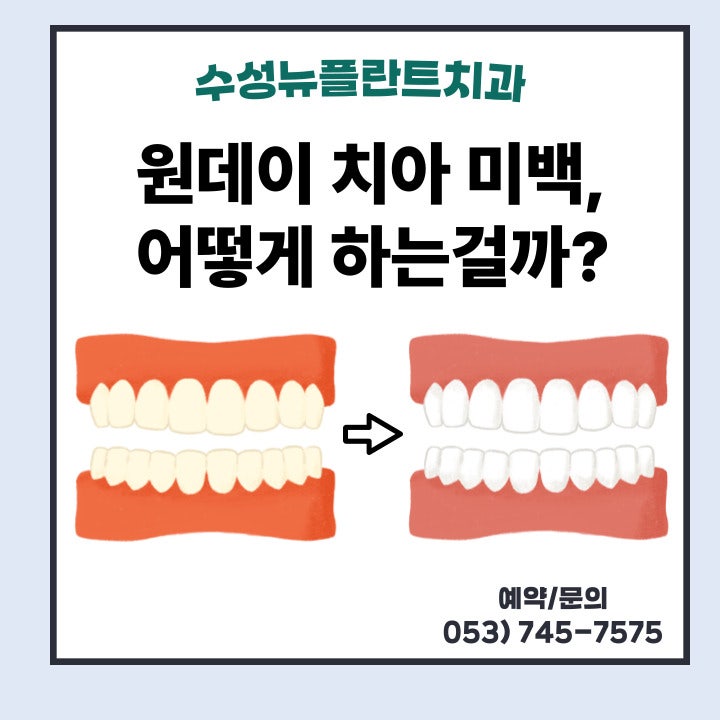 [대구 수성뉴플란트] 원데이치아미백, 어떻게 하는 걸까?