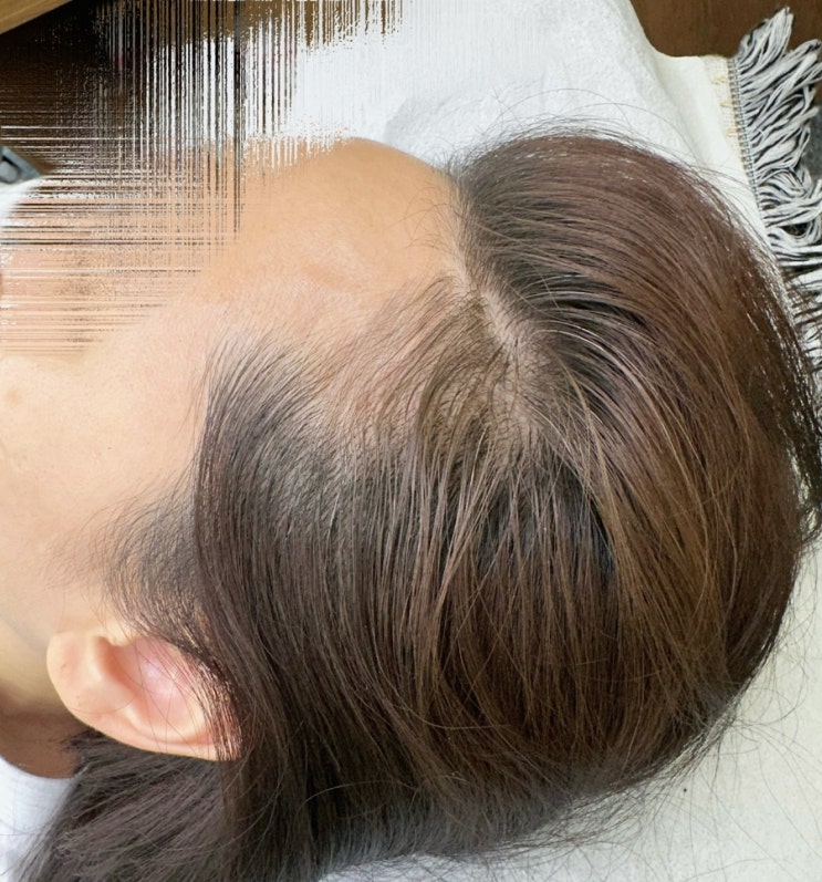 일산 헤어라인 반영구 2차 리터치까지 만족한 <b>아이브</b> :)