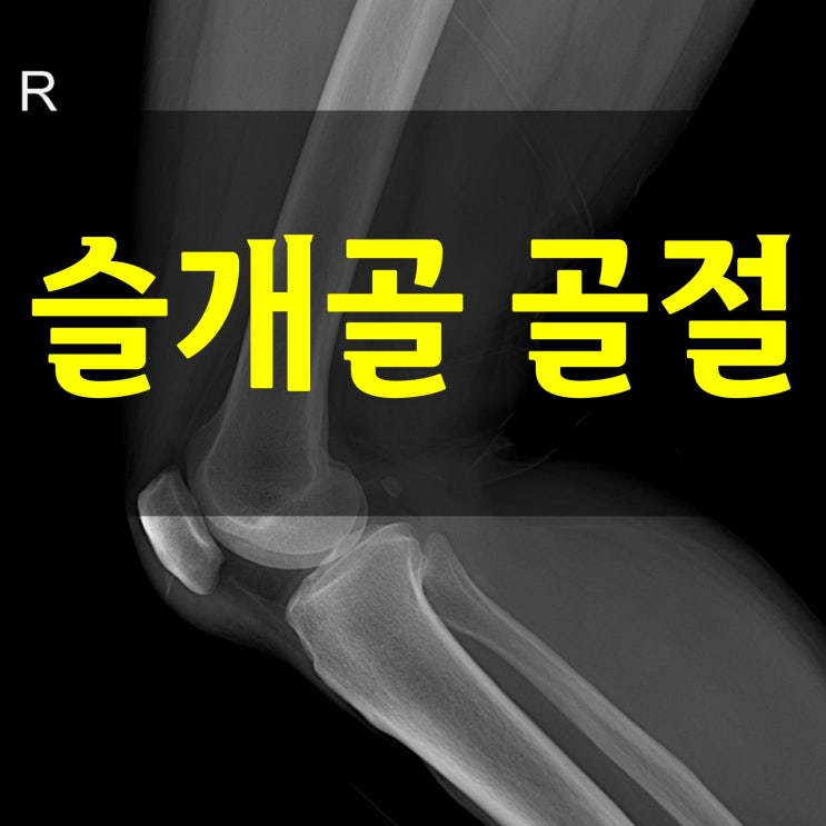 무릎뼈 슬개골 골절, 회복기간과 재활 팁, 접골탕 효능