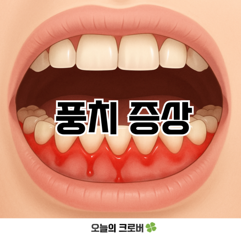 풍치 증상과 치료법, 유전일 수도 있다고요?