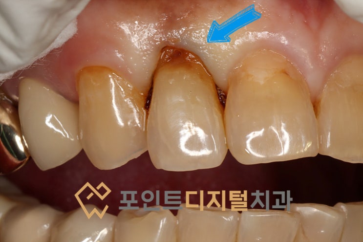  [탕정치과]  앞니 치경부 우식 레진 치료 / 천안 아산 불당 배방