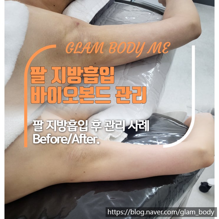 팔 지방흡입 바이오본드 관리 (2주 차 - 8주 차) 비포 & 애프