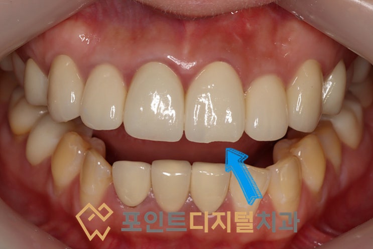  [탕정치과]  앞니 치아 조각이 떨어졌어요.(포셀린 파절 리페어) / 천안 아산