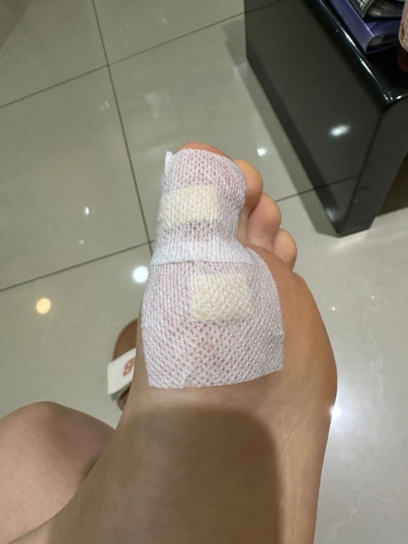 티눈 or 사마귀 치료 방법 (15년째 사마귀 나는 사람의 찐후기)