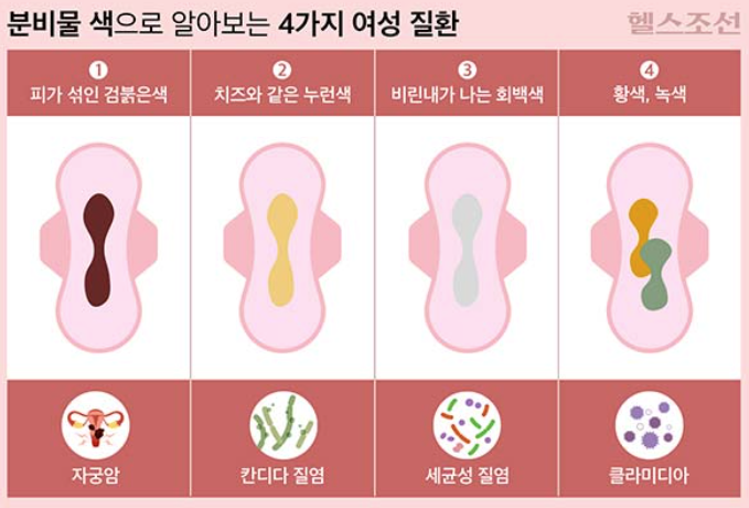   질 분비물 색깔·냄새로 보는 여성 건강 신호 4가지