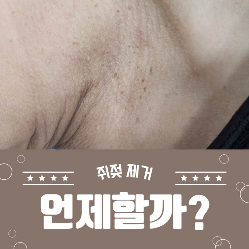 포항쥐젖제거 에이플룸 쥐젖제거 언제 하는 게 좋을까? 원장님도 셀프로 하는 여름철 쥐젖제....