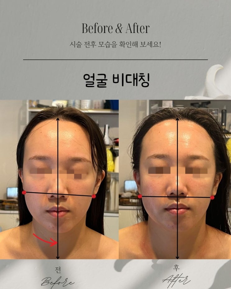  비포애프터 얼굴 비대칭, 자연스럽게 개선한 실제 사례 공개– 부산동래윤곽관리