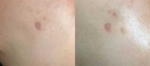  [흉터 치료] 강남역 피부과 쥬베룩 스킨 내돈내산 후기 | 패인 흉터, 포인트 시술, 쥬베룩 효과 등