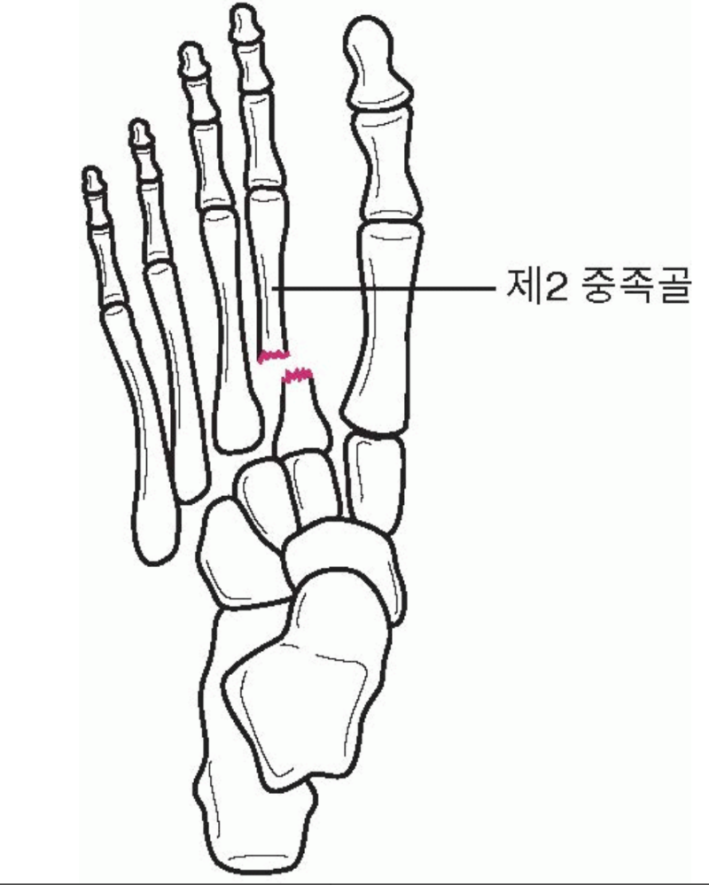 장애인복지론_신체적 장애_지체장애