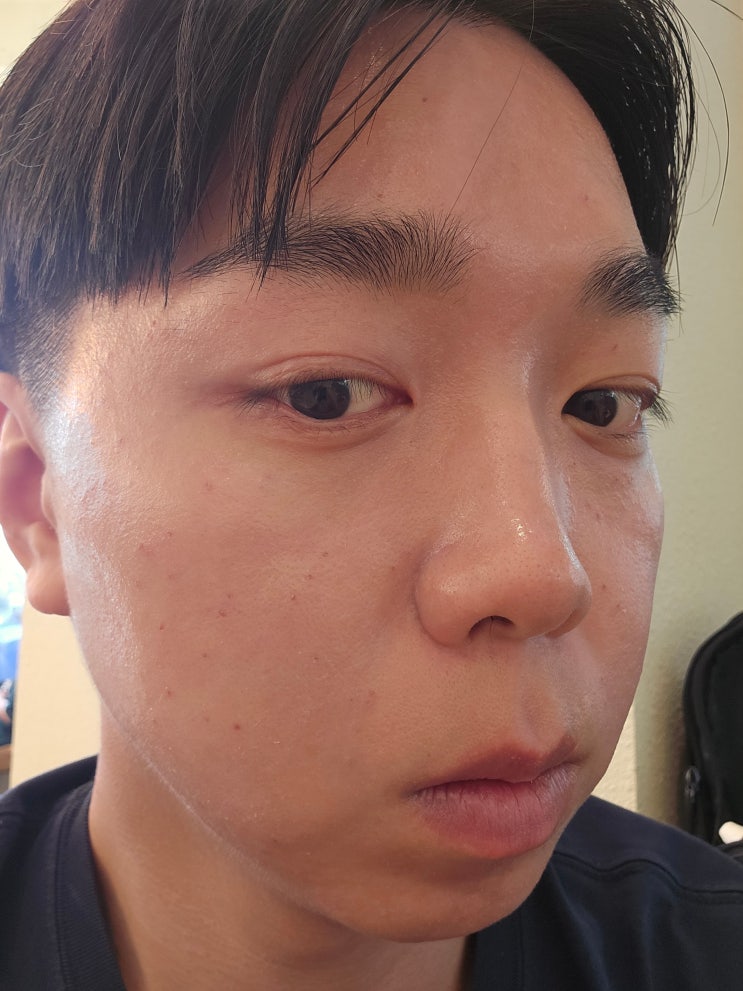  CO2레이저 편평사마귀 제거 후 관리 여신티켓 추천인 코드