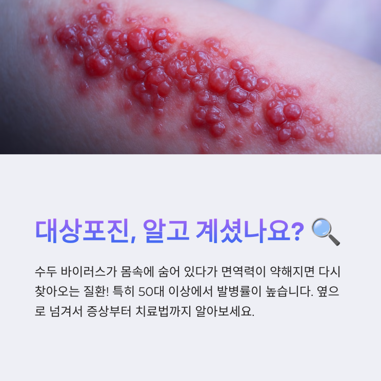  대상포진 증상은 어떤가요? 치료와 백신까지 꼼꼼 정리
