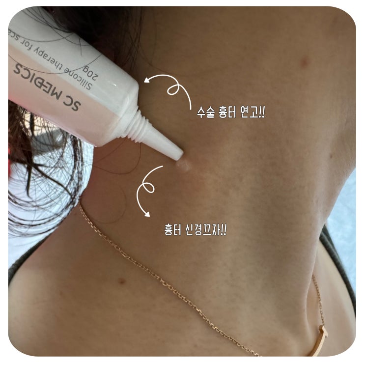  수술 흉터 색소침착 연고 더마에스씨겔 목 옆 신경쓰임이 줄어들겠지