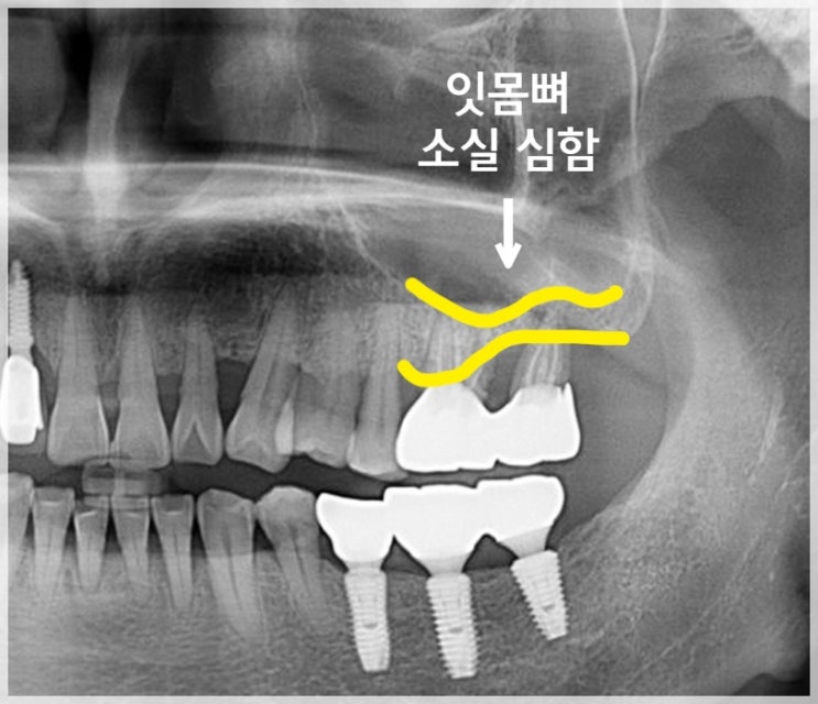  구리역임플란트 잘 하는 곳 찾는 팁 3가지