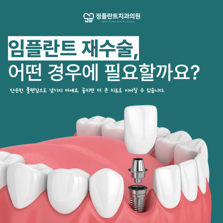  임플란트 재수술, 어떤 경우에 필요할까요?
