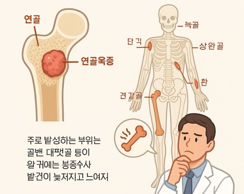 연골육종(Chondrosarcoma) 원인과 증상, 예후와 치료법에 대해