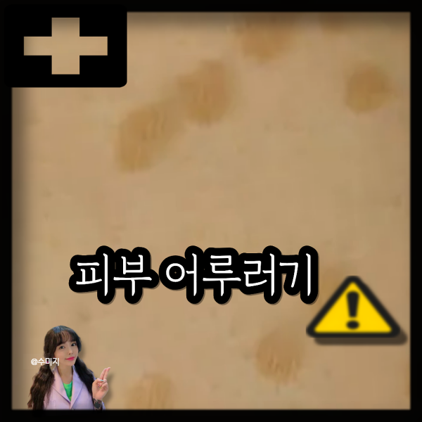 피부 곰팡이균 주의! 어루러기 증상 치료 항진균제 연고 약