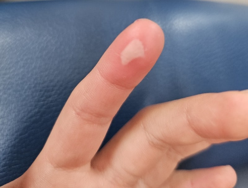 손가락 화상 입으면 병원어디로? 글루건화상 낫는 과정 후기