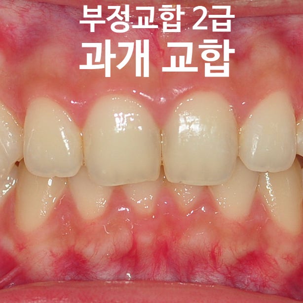 부정교합 2급으로 분석된 과개 교합 돌출입의 교정 전후 변화