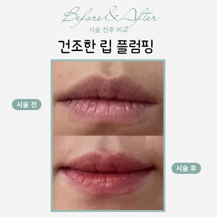  입술이 점점 얇아지고 주름이 생기는 이유, 그리고 필러 대신 선택하는 방법