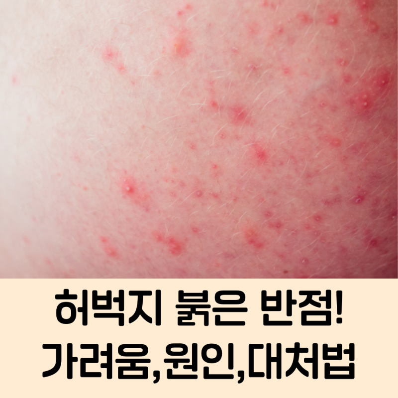 허벅지 붉은 반점과 가려움, 원인과 대처법 정리