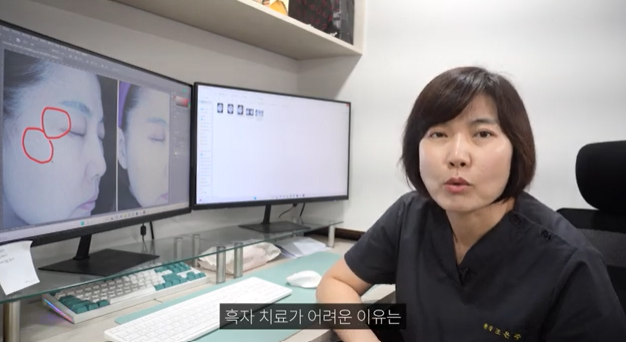  리팟레이저 흑자 재발 부작용 걱정이라면