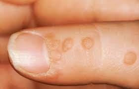 인유두종바이러스(Human Papillomavirus, HPV)와 가다실 예방접종