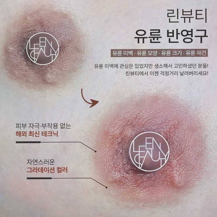  [삐땅기 린뷰티] 헤어라인문신으로 자신감을 되찾다