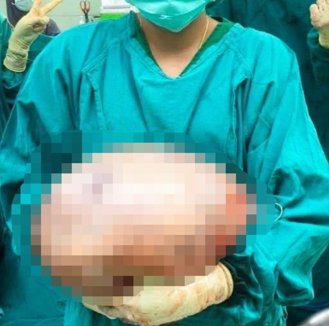  [태국] 여성, 배불림 원인은 ‘8kg 거대 난소 낭종’