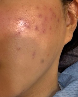 부산여드름흉터 한의원ㅣ새살침 패인흉터치료 6회차 내돈내산 후기