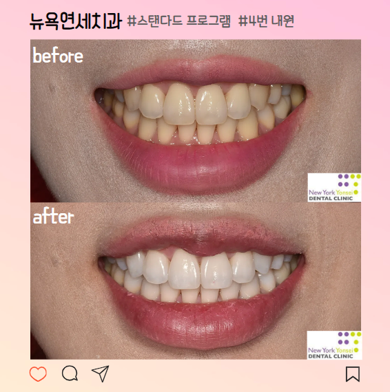  강남역치아미백 4회 패키지 후기, 전후 변화, 이시림