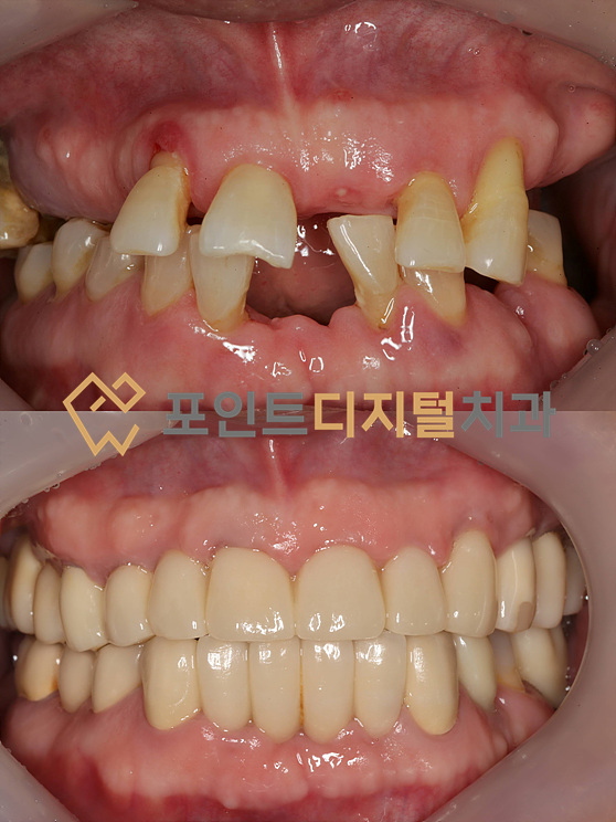  [탕정임플란트]  밝게 웃으셔서 너무 좋았습니다 : 전악수복(발치즉시 임플란트, 덴티움) / 천안 아산 불당 배방