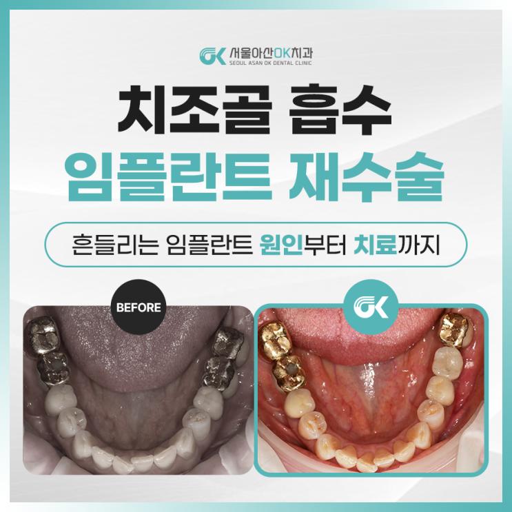  [임상사례] 미사양심치과, 치조골 흡수로 인한 임플란트 재수술 과정