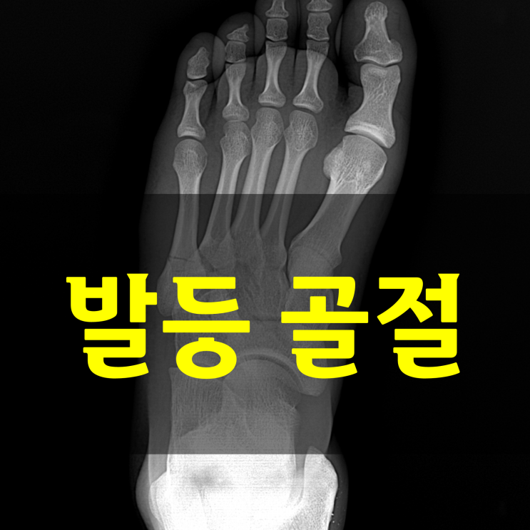  발등뼈 골절, 얼마나 지나야 마음껏 걸을 수 있을까요? (회복기간과 관리법)