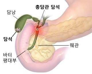 담낭 쓸개 담석