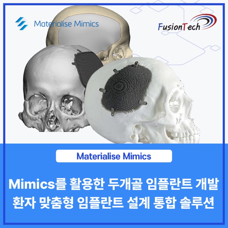  [Materialise S/W] Mimics를 활용한 두개골 임플란트 개발 - 환자 맞춤형 임플란트 설계를 위한 효율적인 통합 솔루션!