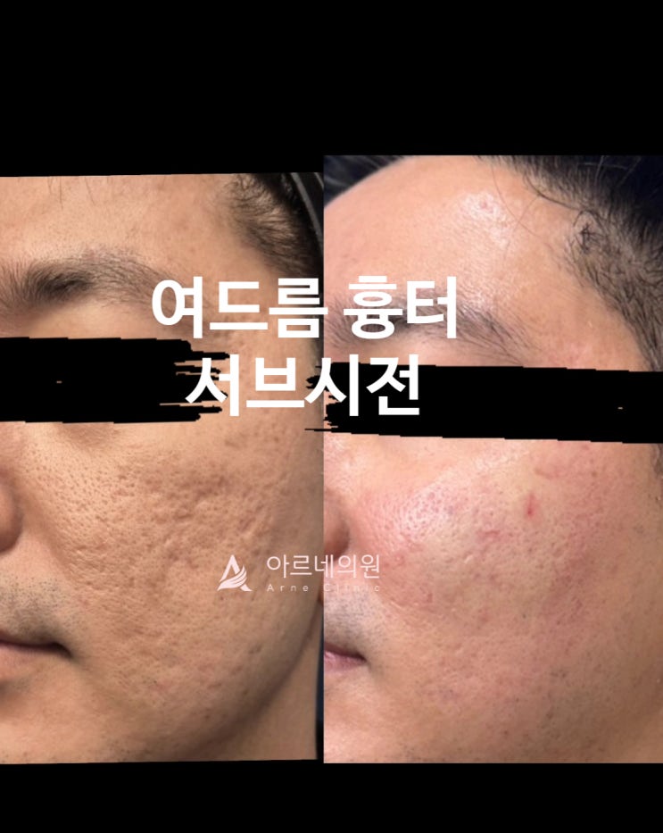  얼굴 여드름흉터 치료 서브시전 피부과, 3단계 맞춤시술로 피부결 되찾기