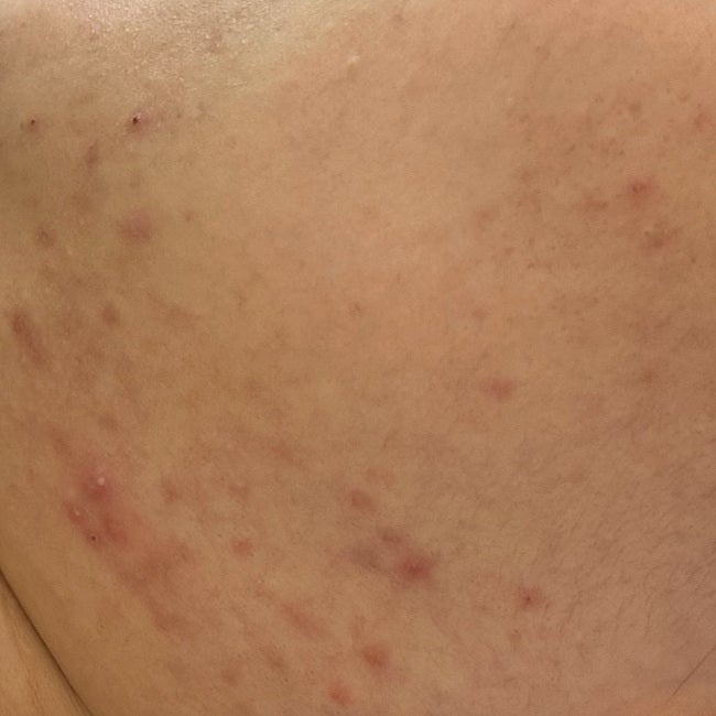 오메가3 여드름? 피부 염증 부작용 하루섭취량 후기