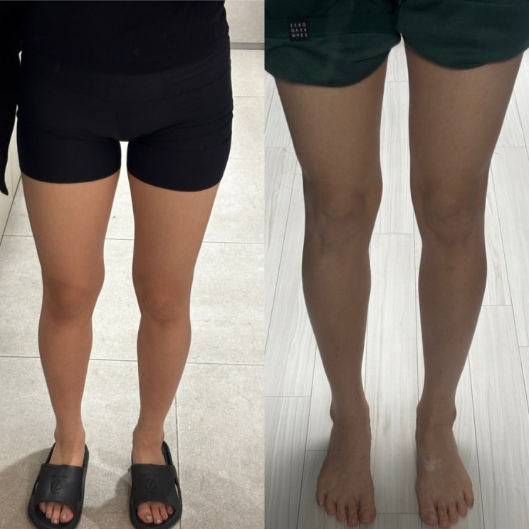  허벅지 지방분해주사 제로팻 3회차! 드디어 다리라인 완전 달라짐 제팻주 솔직후기 대공개