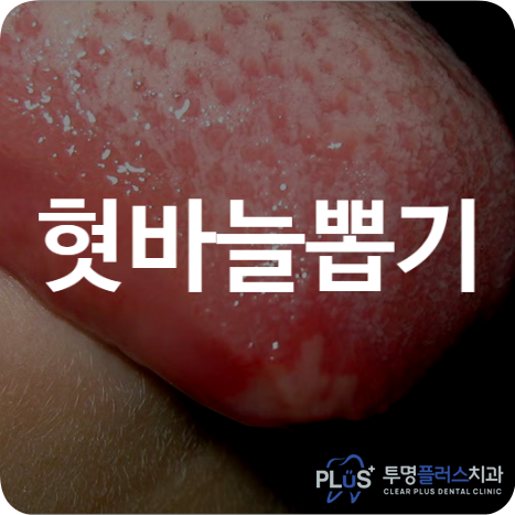 혓바늘 뽑기 구내염 뽑으면 없애는방법 약국약 스트레스