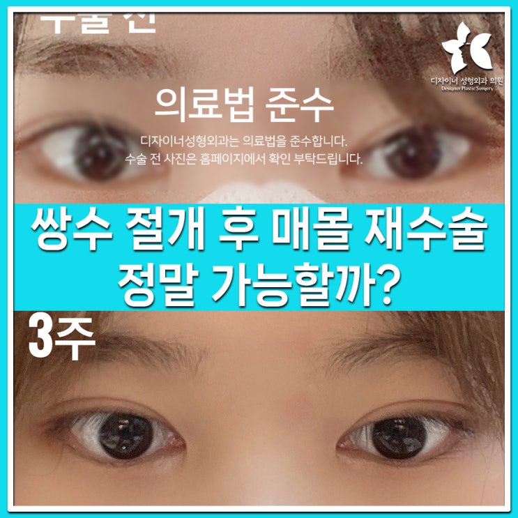  쌍수 절개 후 매몰로 재수술, 정말 가능할까?