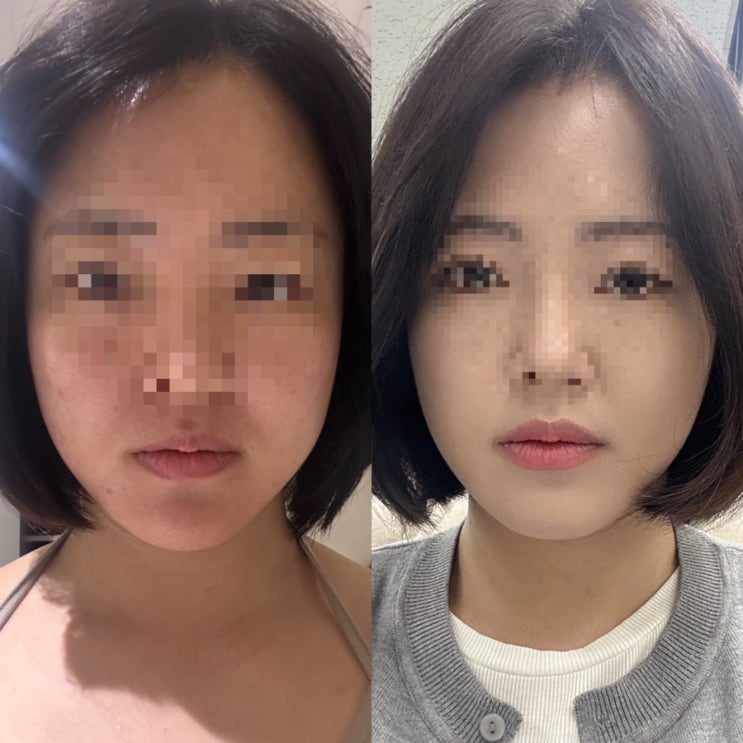  내돈내산 온다리프팅! 온다리프팅 60kj 받은 리얼후기