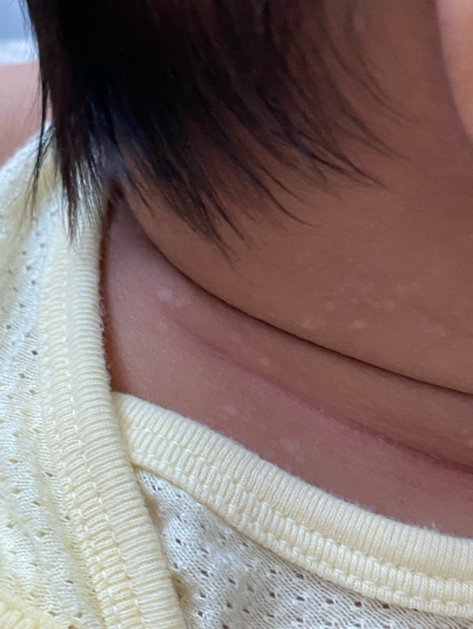 아기 피부 곰팡이균 어루러기 치료해야할까