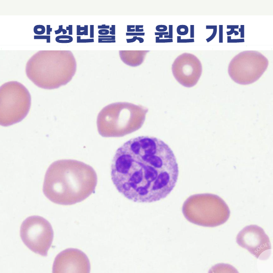 악성빈혈 뜻 원인 비타민 B12 내인자 내인성인자 부족