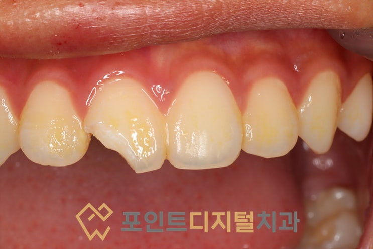  [탕정치과]  앞니 치아파절 크라운 대신 레진으로 치료하기 / 천안 아산 불당 배방