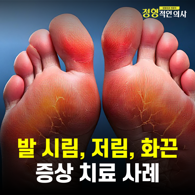  발바닥이 저리고 시리고 뭐가 붙어 있어요. 말초신경병증(의사작성)