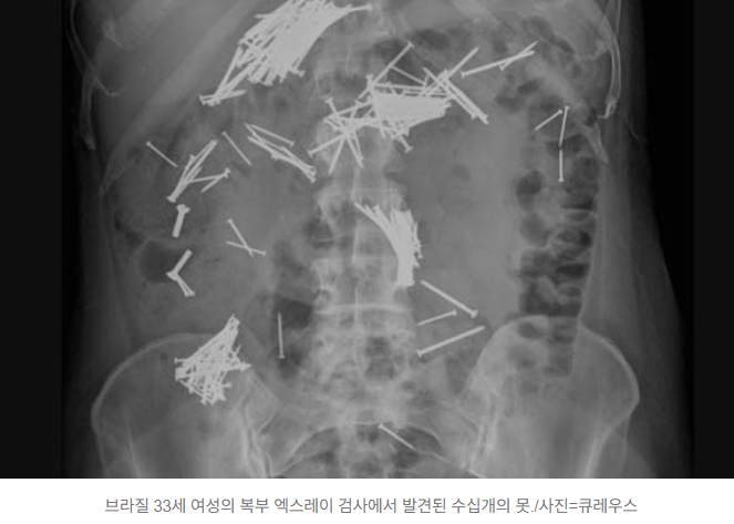  30대 여성, 금속 못 수십 개 삼켰으나 수술 없이 배출