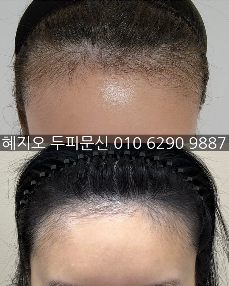  잔머리처럼 감쪽같은 송도 여자 두피페인팅 비용 가격 정보