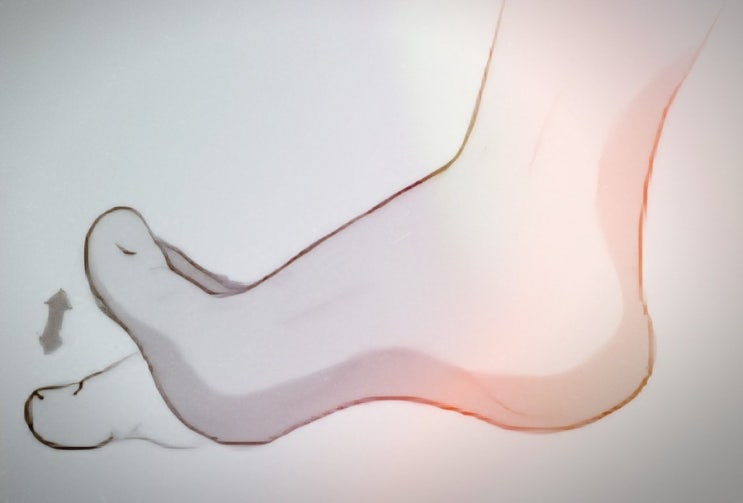   아침 첫발 발뒤꿈치 통증? 족저근막염 원인과 치료법 완벽 가이드 