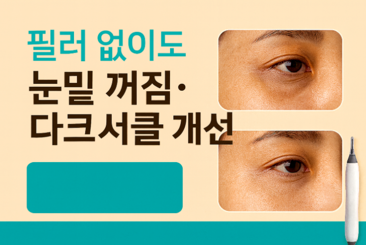  필러 없이 눈밑  개선 – 콜라겐 주사,고주파,잼버실